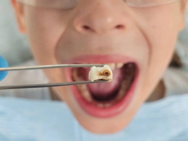 Best Tooth Infection Emergency Dentist  in Belle Rose, LA